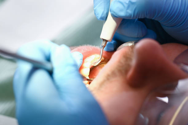 Best Emergency Dental Care for Broken or Chipped Teeth in Casey, IL