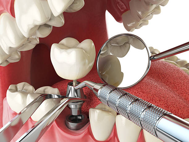 Best Urgent Care for Lost Fillings or Crowns in Casey, IL